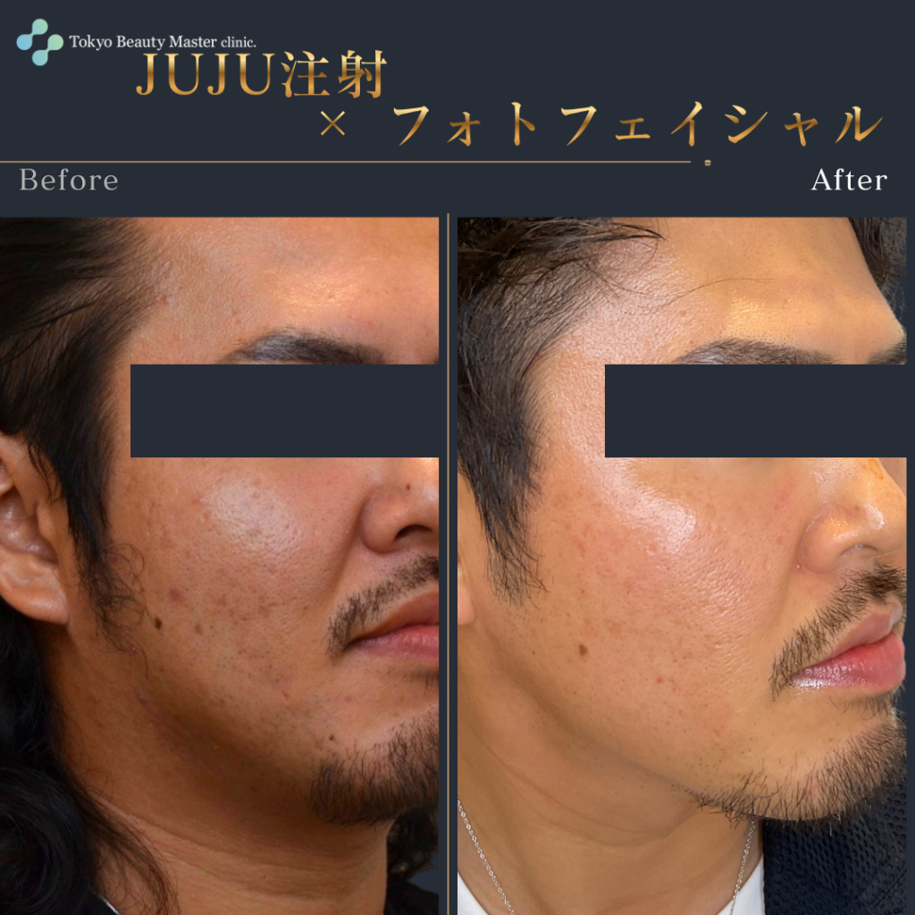 フォトフェイシャル（症例写真3）