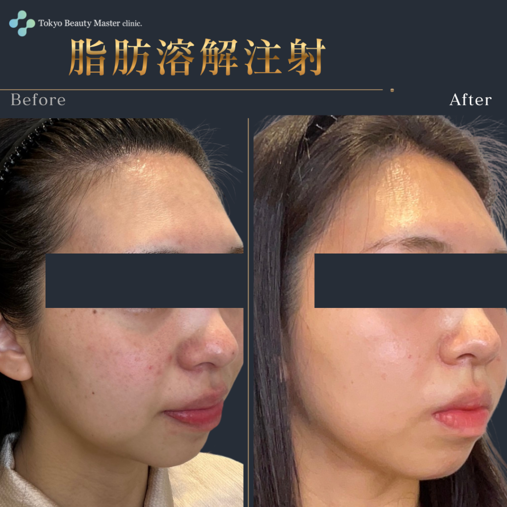 脂肪溶解注射（症例写真1）