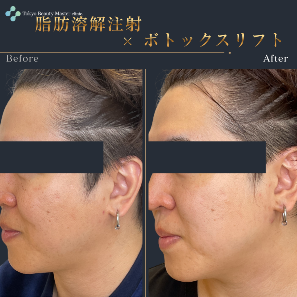 脂肪溶解注射（症例写真2）