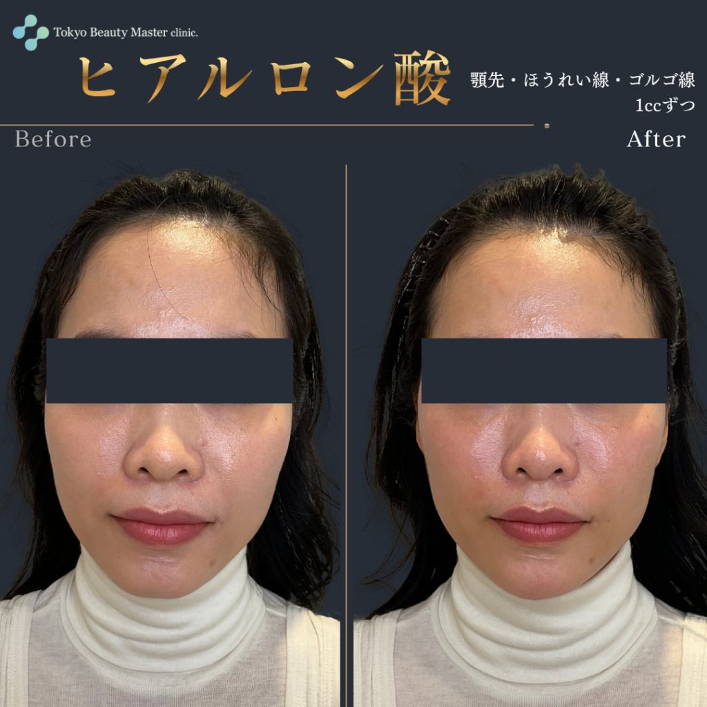 ヒアルロン酸治療（症例写真2）