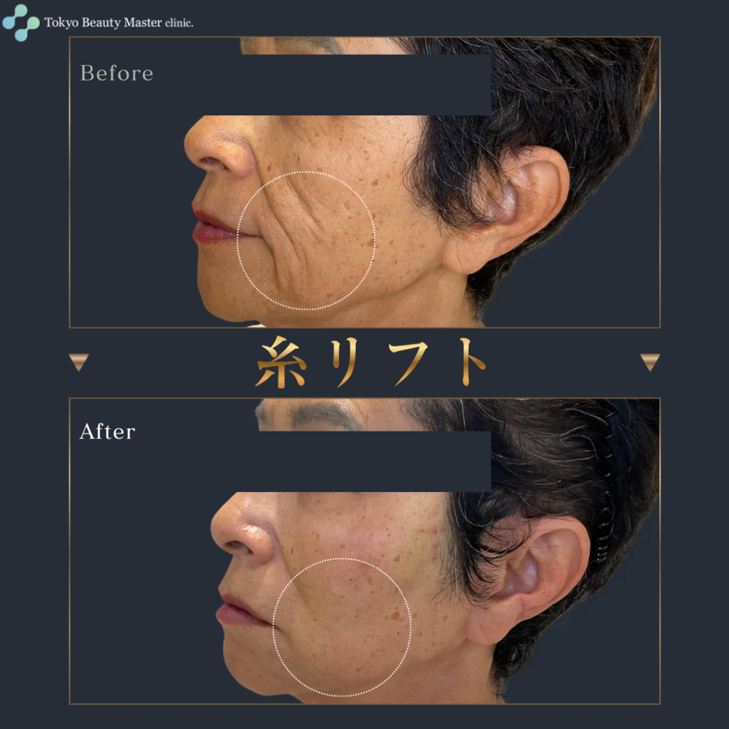 糸リフト（症例写真1）