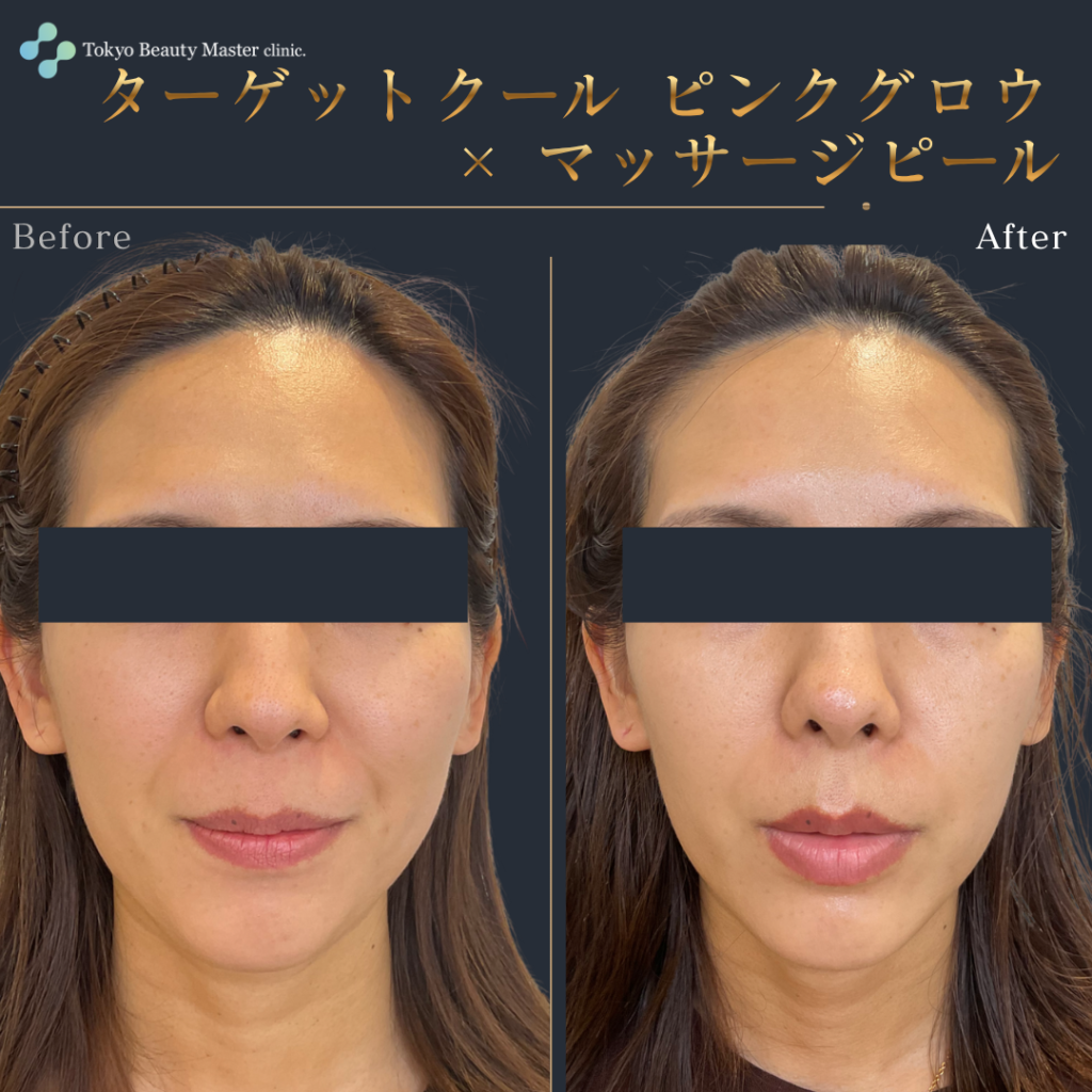 ターゲットクール（症例写真3）