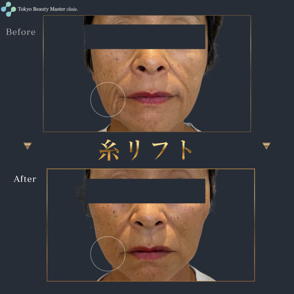 糸リフト（症例写真2）