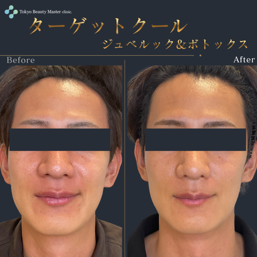 ターゲットクール（症例写真2）