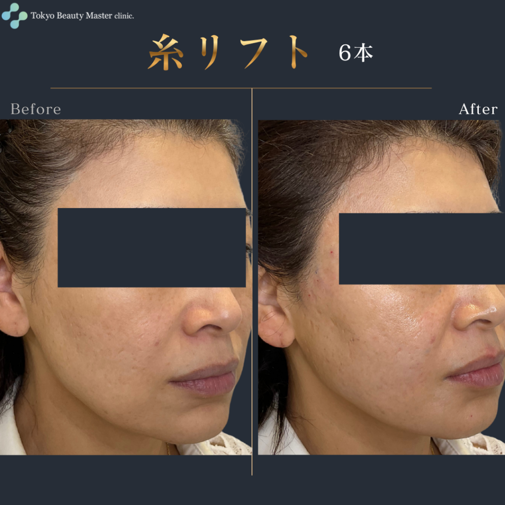 糸リフト（症例写真4）