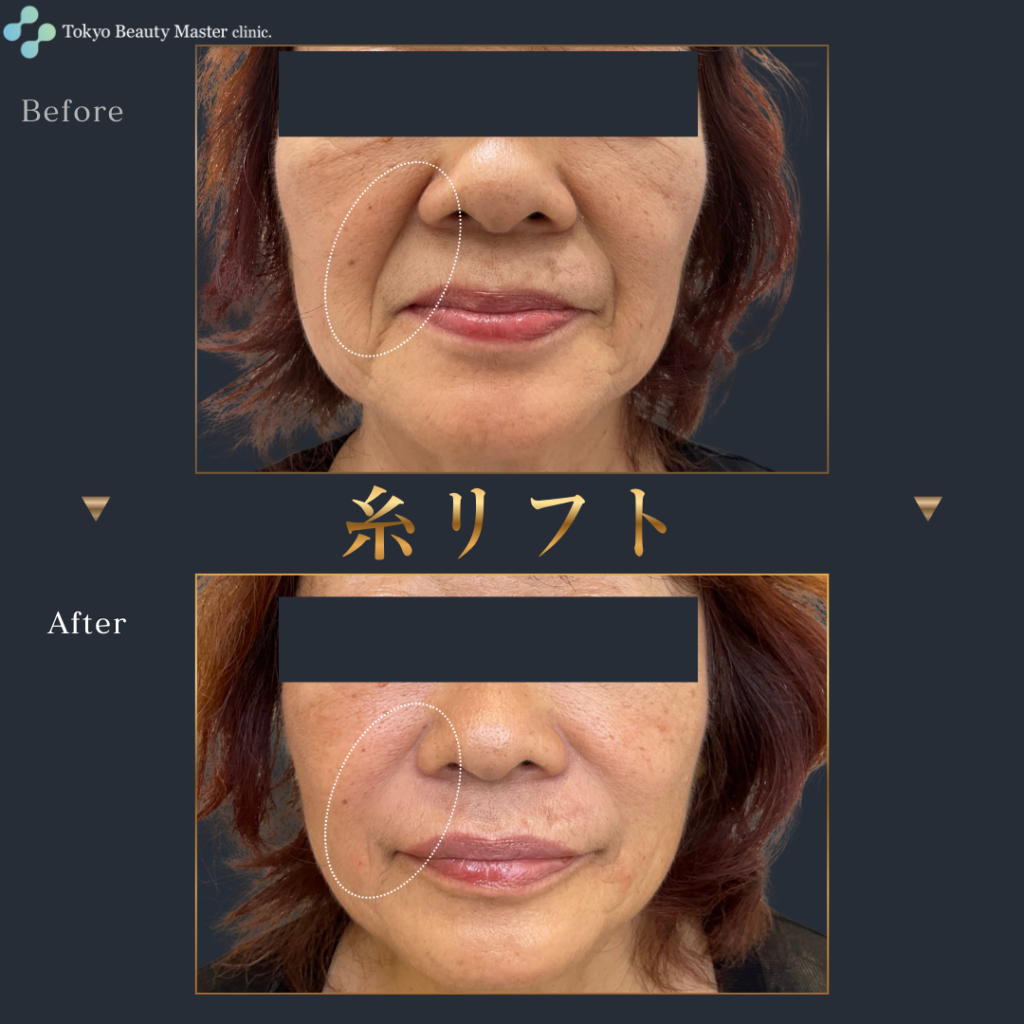 糸リフト（症例写真3）